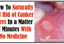 Brilliant ways to soothe a canker sore