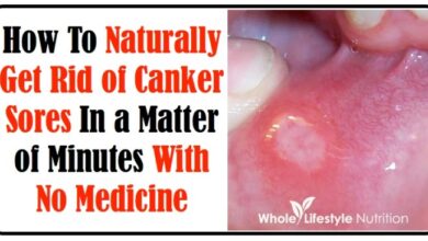 Brilliant ways to soothe a canker sore