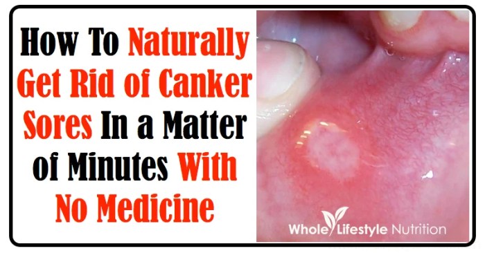 Brilliant ways to soothe a canker sore