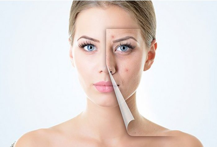 Control over acne